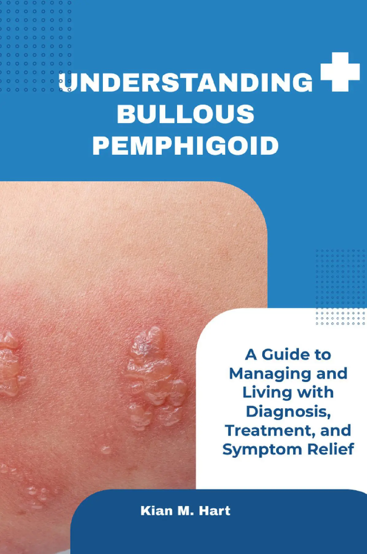 Understanding Bullous Pemphigoid