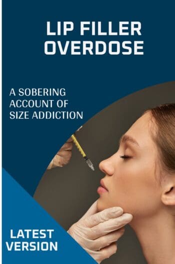 Lip Filler Overdose: A Sobering Account of Size Addiction