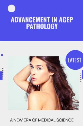 Advancement in AGEP Pathology