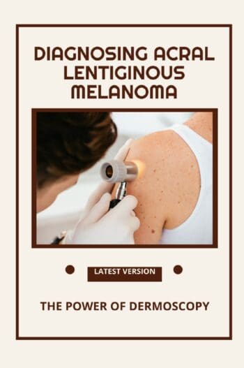 Diagnosing Acral Lentiginous Melanoma