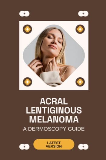 Acral Lentiginous Melanoma